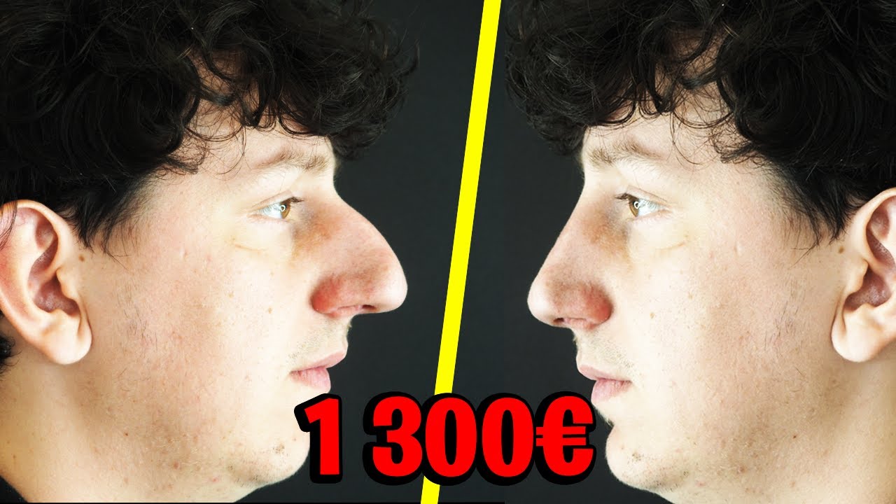J'ai fais une rhinoplastie en France pour 1300€ (Résultat bluffant)