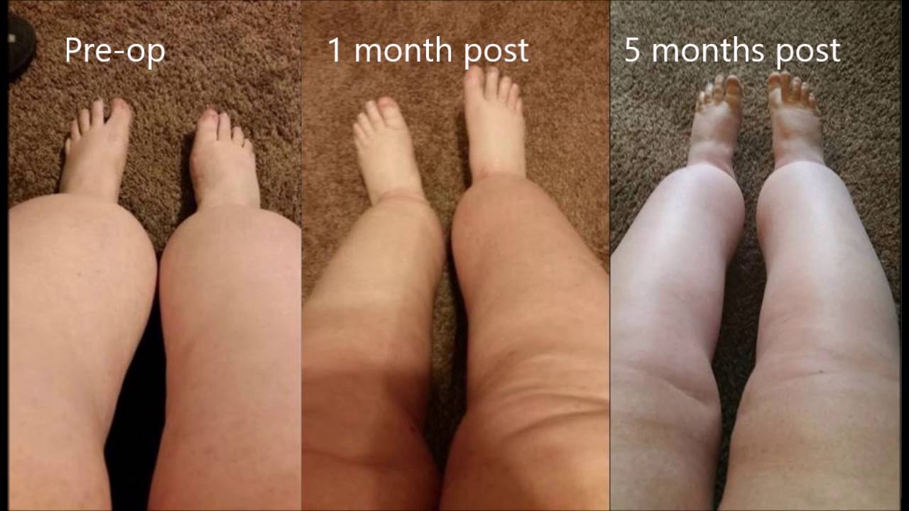 Lipedema Awareness Month: Marlene's post-surgical progress