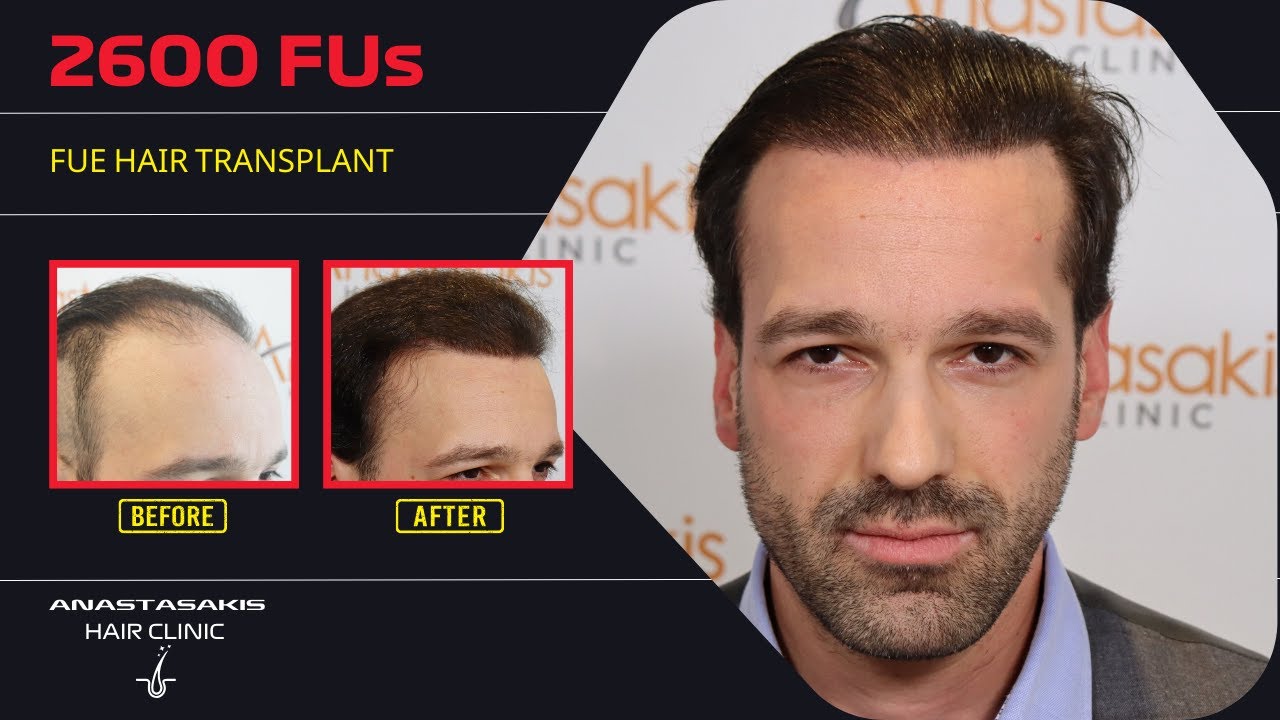 Από στάδιο 5 σε φυσικό hairline με 2600 τθ FUE! 🔥✨ | 12 μήνες μετά - case #419a