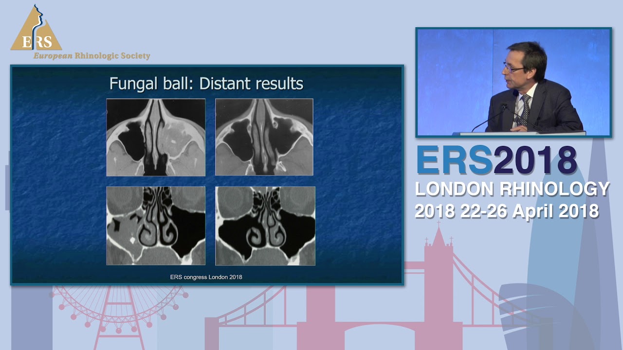 ERS London 2018, Secondary CRS; Odontogenic Disease, Andrey Lopatin