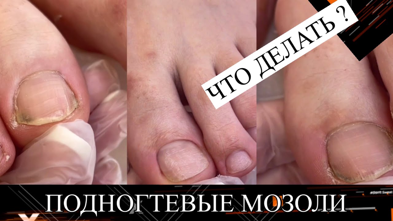 Педикюр 🦶ПОДНОГТЕВЫЕ Мозоли / Впервые на педикюре