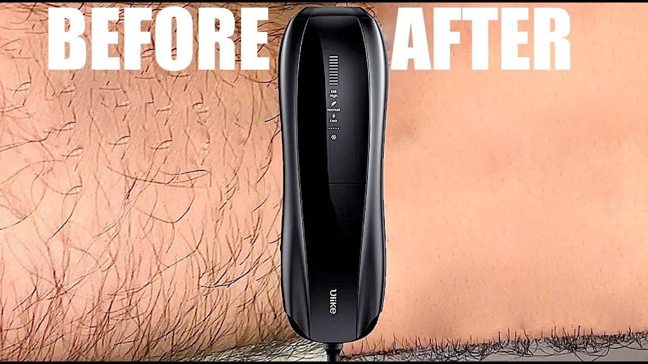 Does IPL Hair Removal Work For MEN Too? Ulike X Laser Hair Removal For Men