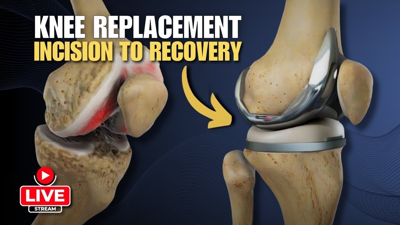 Everything You Need To Know About Knee Replacement Surgery