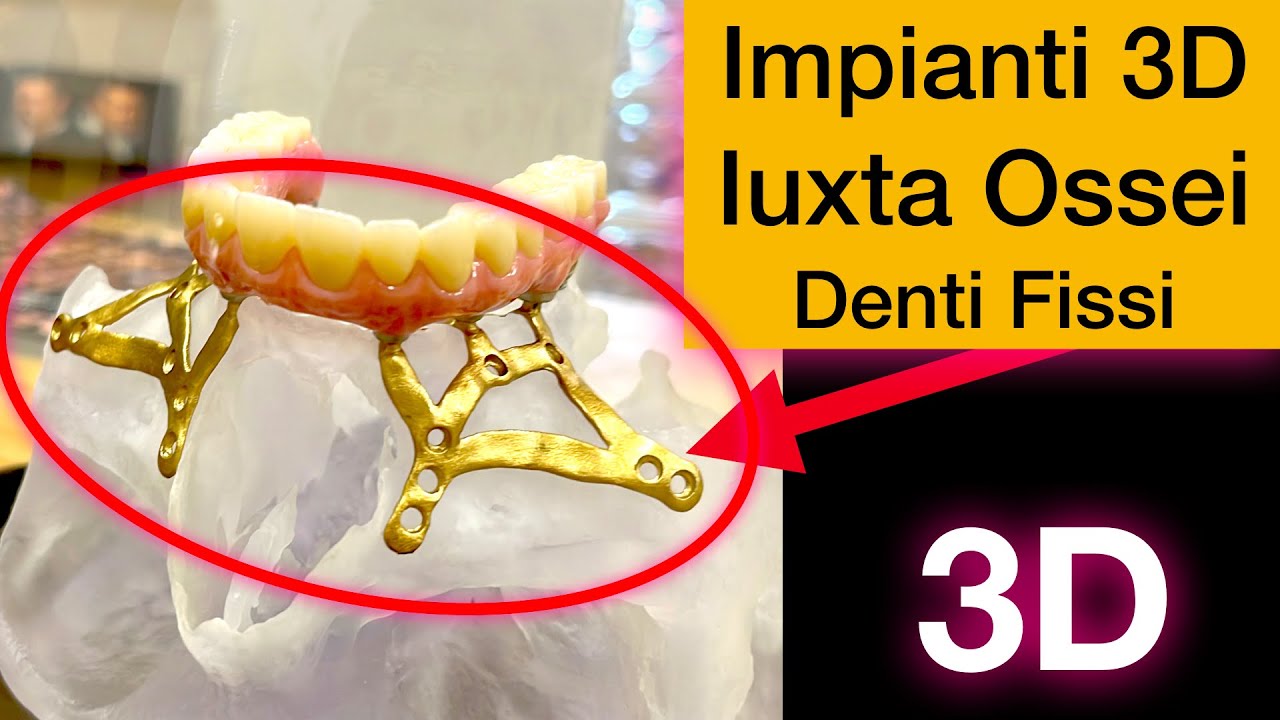 Denti Fissi Senza Osso griglie sottoperioistee
