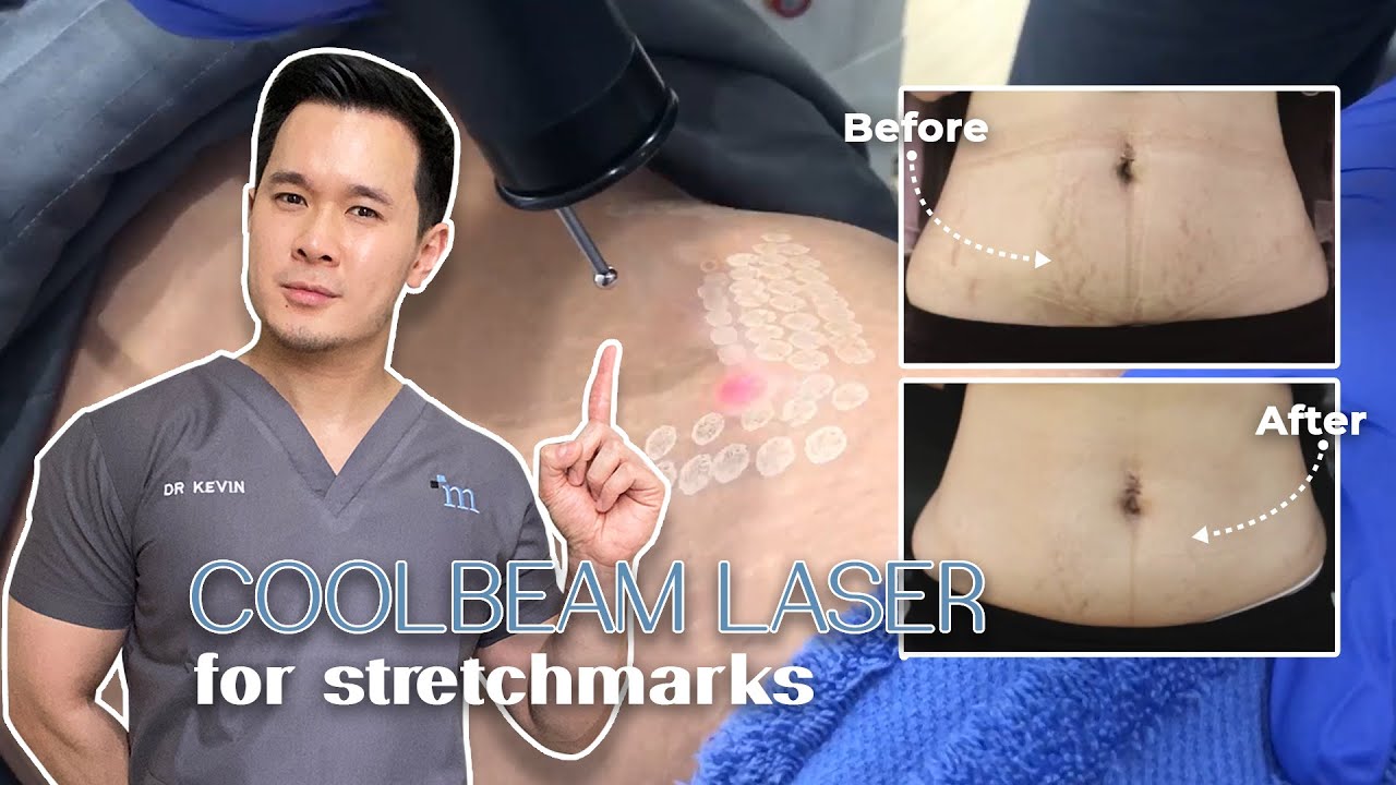 CARA AMPUH DAN CEPAT HILANGKAN STRETCHMARK DENGAN HASIL PERMANEN!