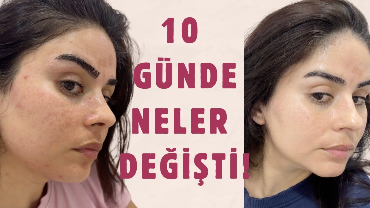 BUNU BENDE BEKLEMİYORDUM : EN İYİ PDRN &Uuml;R&Uuml;N&Uuml; HANGİSİ ?