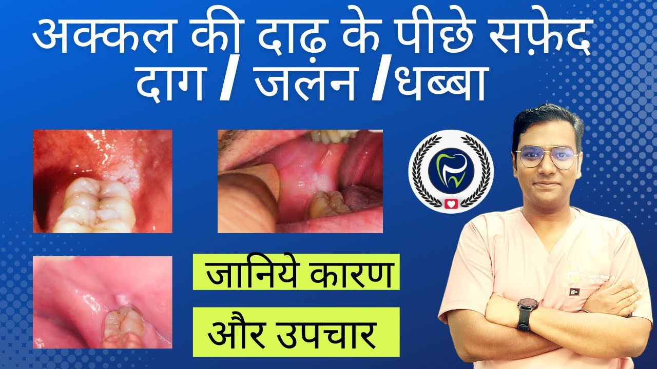 Dr Rudra Mohan | अक्कल की दाढ़ के पास सफ़ेद धब्बा /दाग/जलन ?? कारणों और उपचार को समझें | White patch