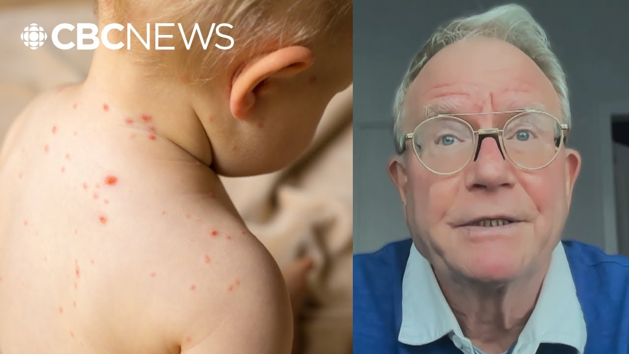 Ex-chief medical officer 'saddened' by Alberta's role in loss of measles elimination status