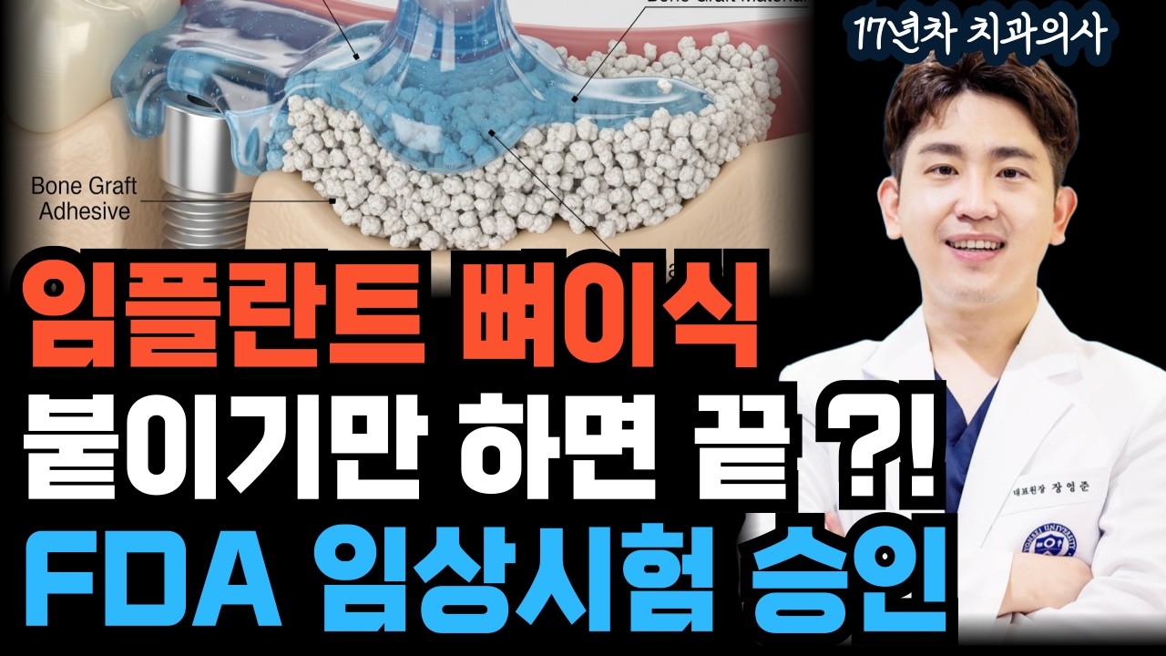 임플란트 뼈이식, 이제 붙이기만 하면 끝 ? FDA 임상 시험 승인 #테트라나이트