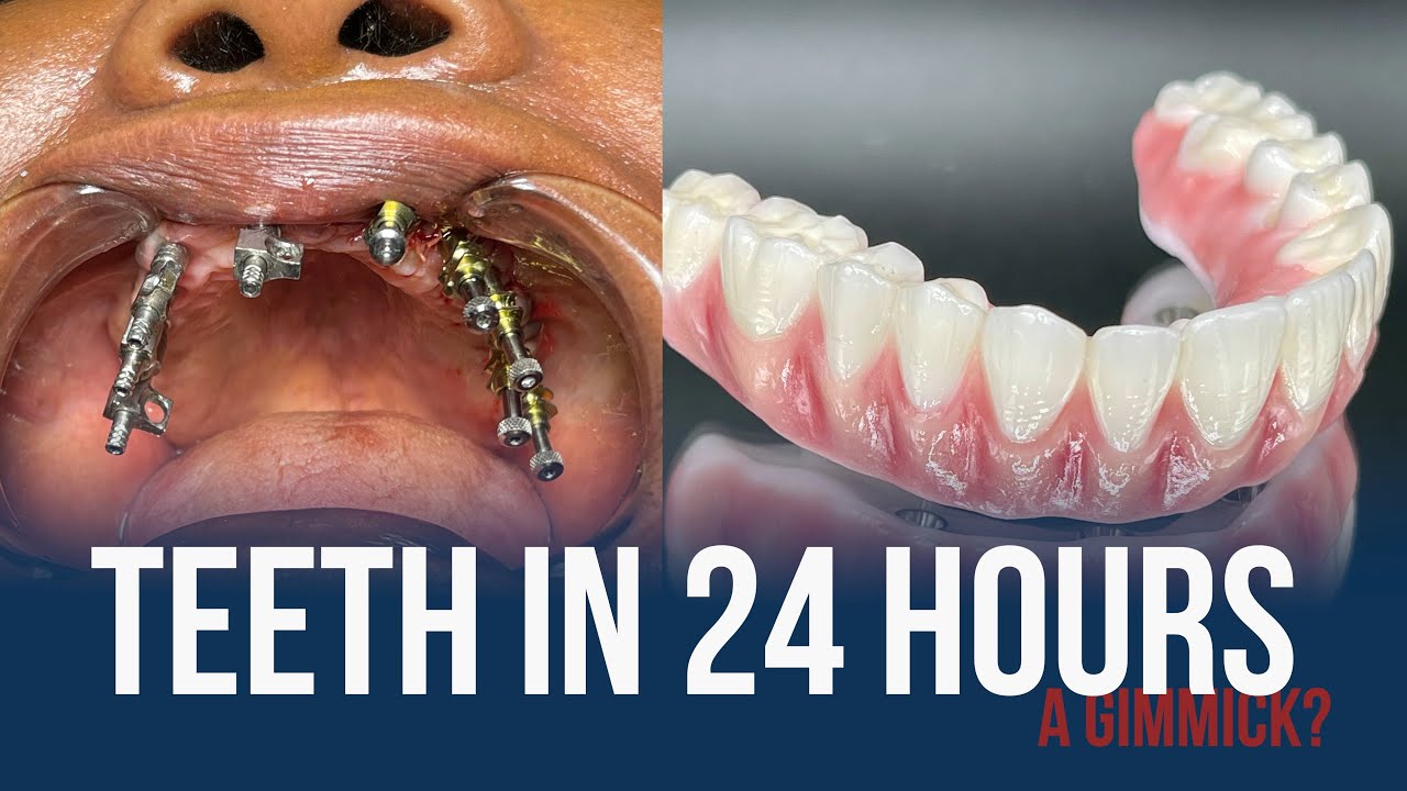 Must Watch! TEETH IN 24 HOURS is a gimmick!