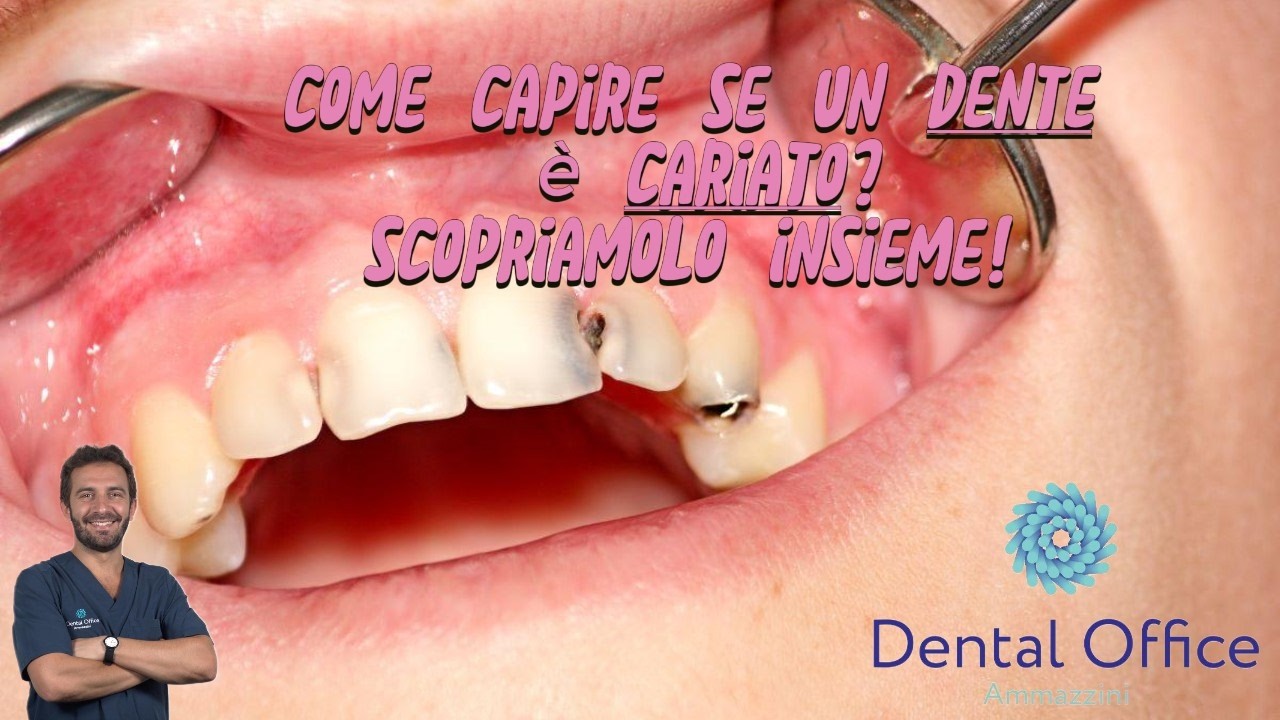 TRE MODI per capire se hai DENTI CARIATI!!