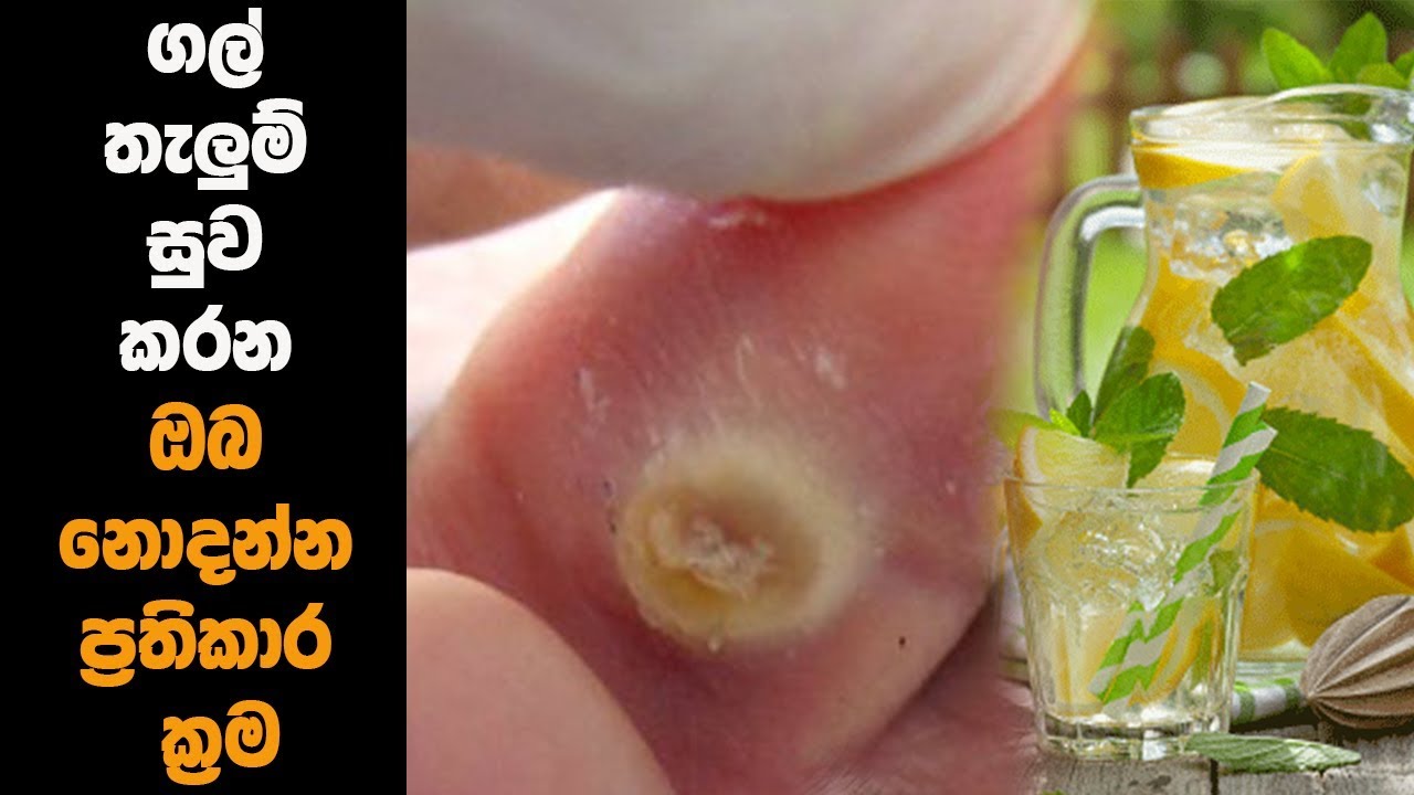 ගල් තැලුම් සුව කරන ඔබ නොදන්නා ප්&zwj;රතිකාර මෙන්න