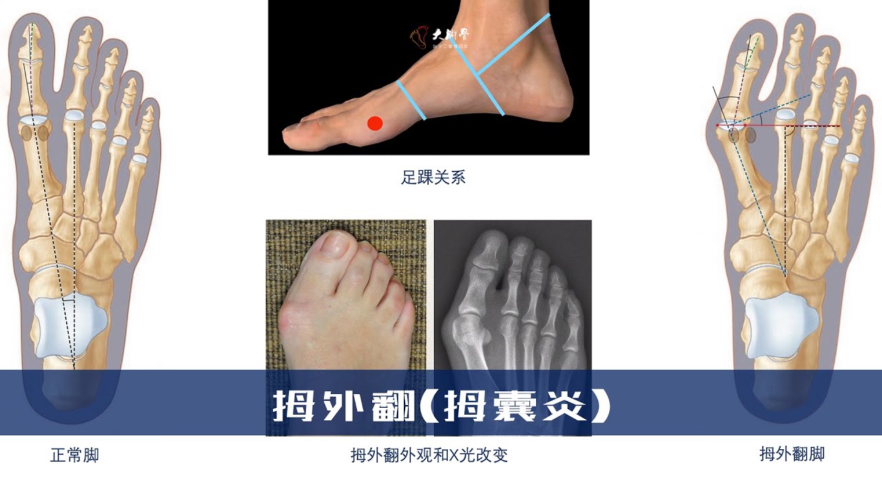拇外翻是什么？拇囊炎如何防治