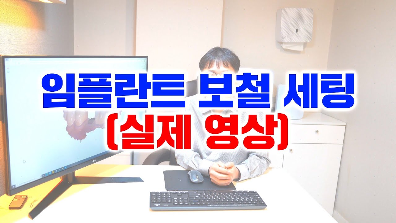 임플란트 보철 세팅(실제영상)