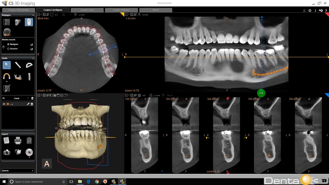 CS 3D Imaging - Tracé du canal mandibulaire