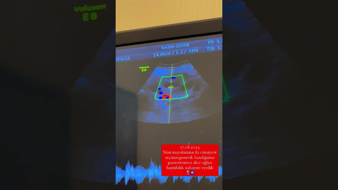 S&uuml;ni mayalanma ilə cinsiyyət se&ccedil;imi+genetik baxdığımız pasientimizə əkiz hamiləlik xəbərini verdik🤰