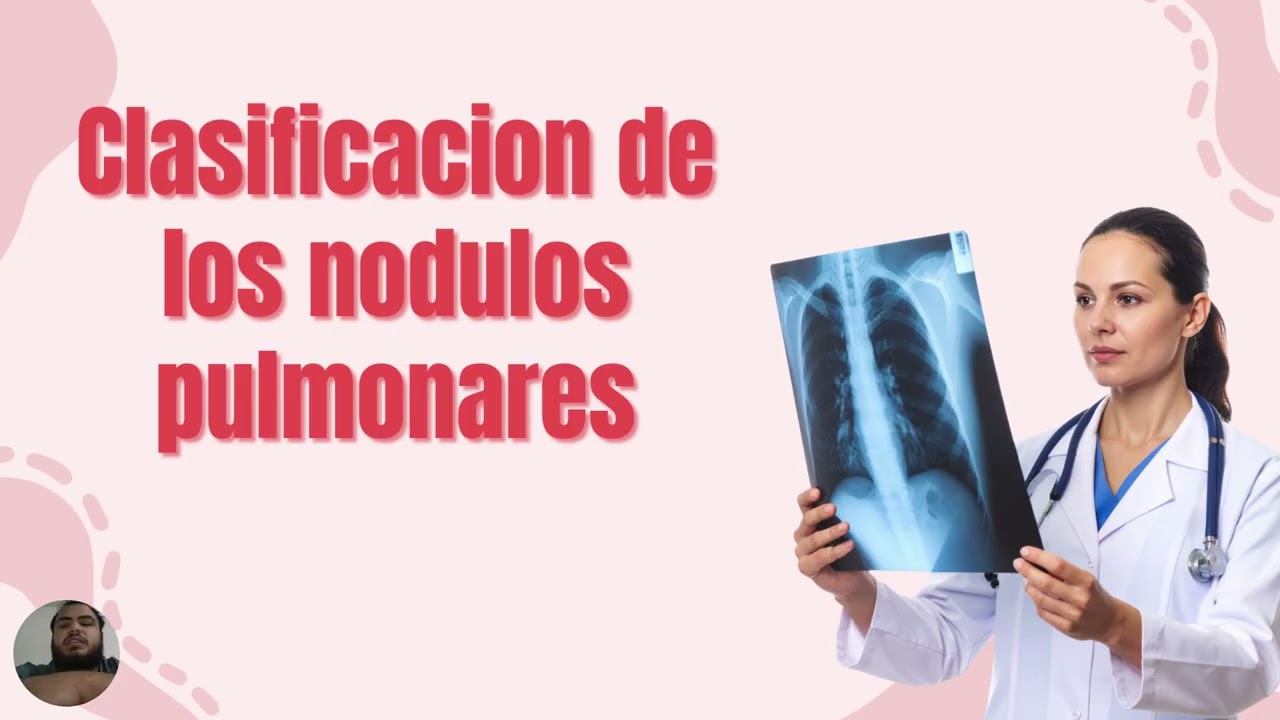 Nódulos pulmonares