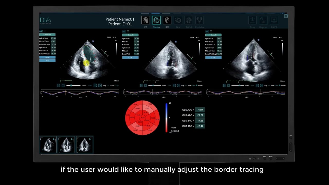 LVivo Seamless&trade;-Enhance Your Echo Lab Workflow