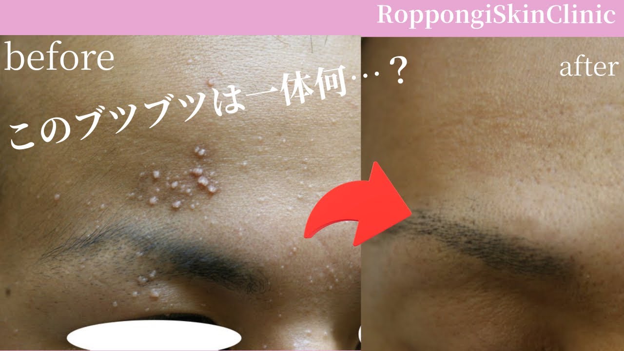ウイルス性イボ（青年性扁平疣贅、尋常性疣贅）の治療｜レーザーと薬剤どっちがいい？症例で解説