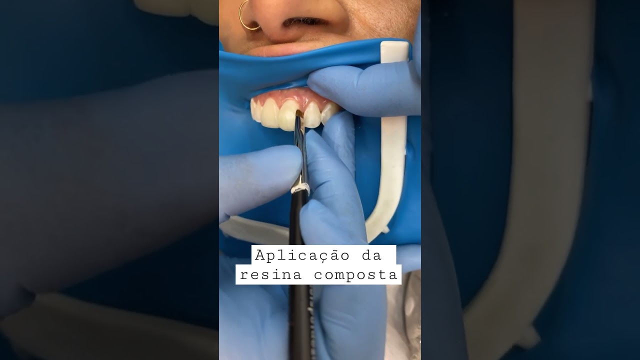 🎯Aplica&ccedil;&atilde;o da resina composta em um caso de faceta de resina #facetas #dentista
