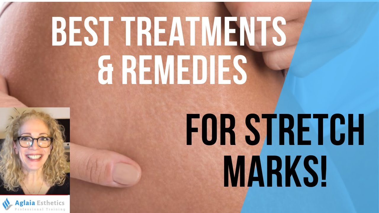 EASY WAYS TO FADE STRETCH MARKS FAST!