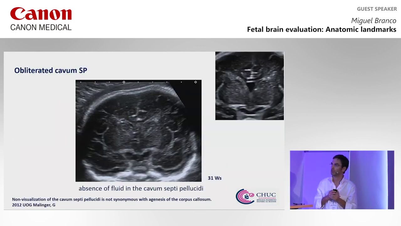 ISUOG 2019   Miguel Branco on utilizing ultrasound imaging techniques during fetal brain evaluation