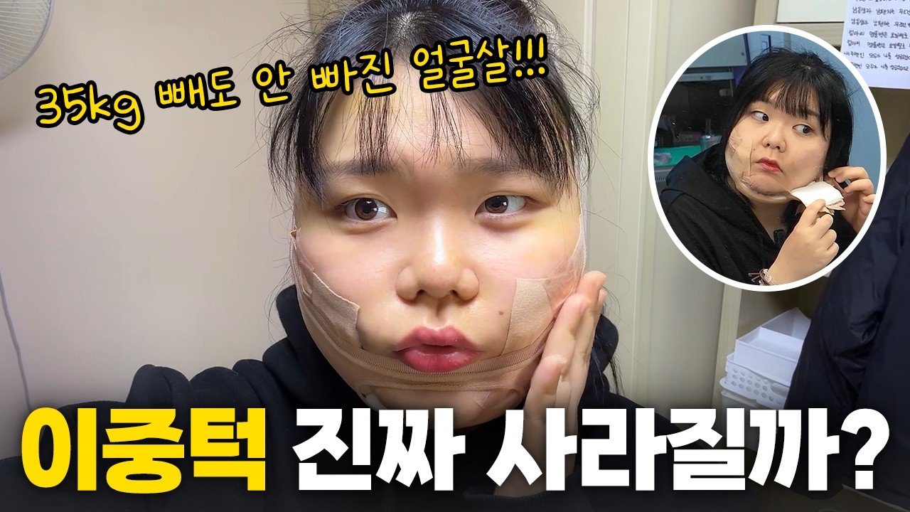 35kg 빼도 얼굴살은 그대로… 결국 지방흡입 했습니다 과연 이중턱이 사라질까요? [찬빛Vlog]