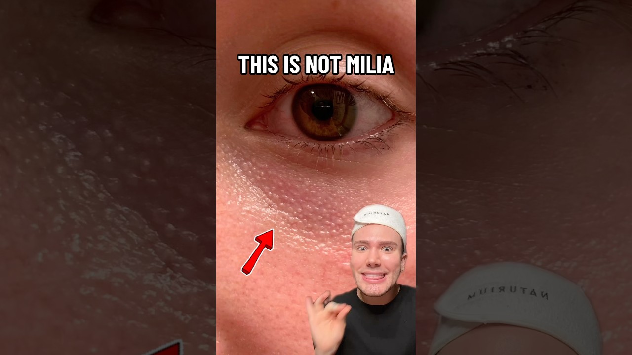 HOW TO GET RID OF EYE BUMPS!😱 (follow for more!💗) #skincare #skincareroutine #skin #eyes #beauty