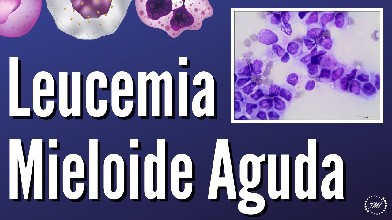 Leucemia Mieloide Aguda