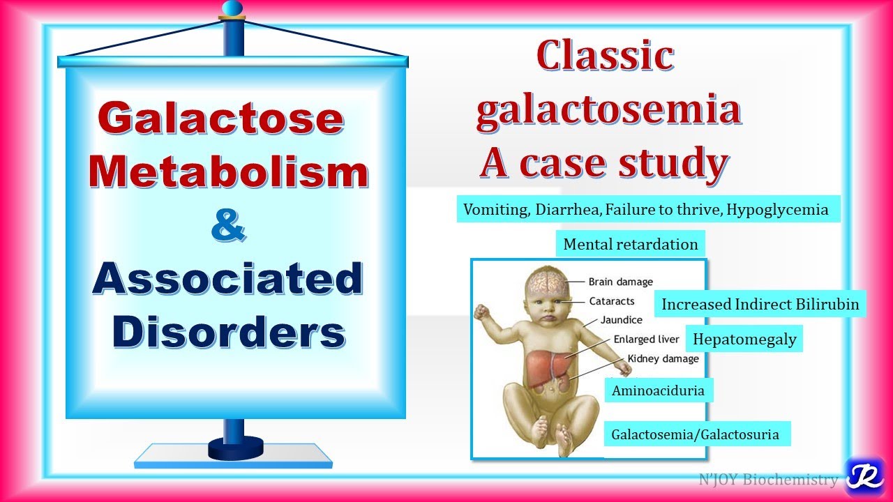 22: Galactose metabolism & Associated Disorders | carbohydrates Metabolism | Biochemistry