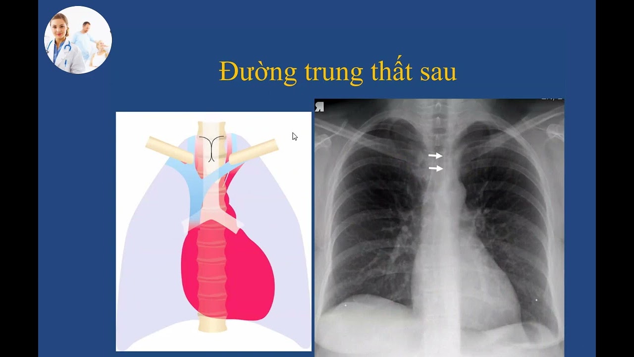 HỘI CHỨNG TRUNG THẤT | TS. BS. ĐOÀN TIẾN LƯU
