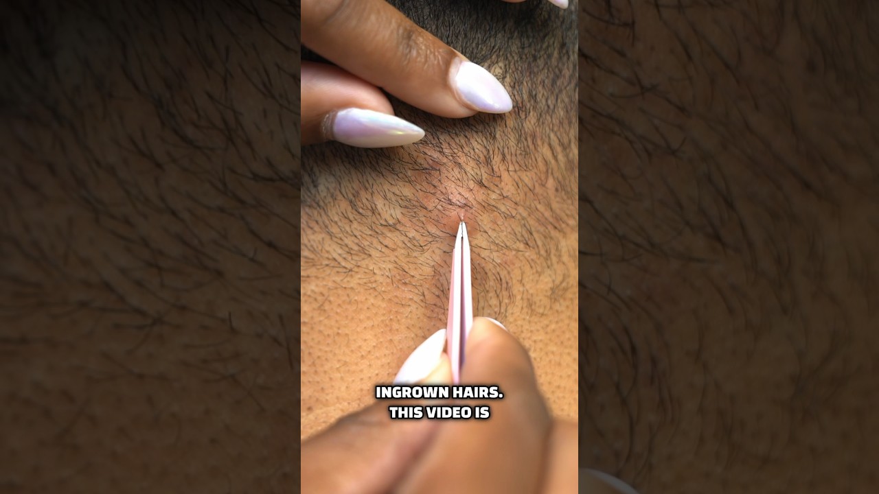 Getting Rid of Ingrown Hairs: Treatment & Prevention