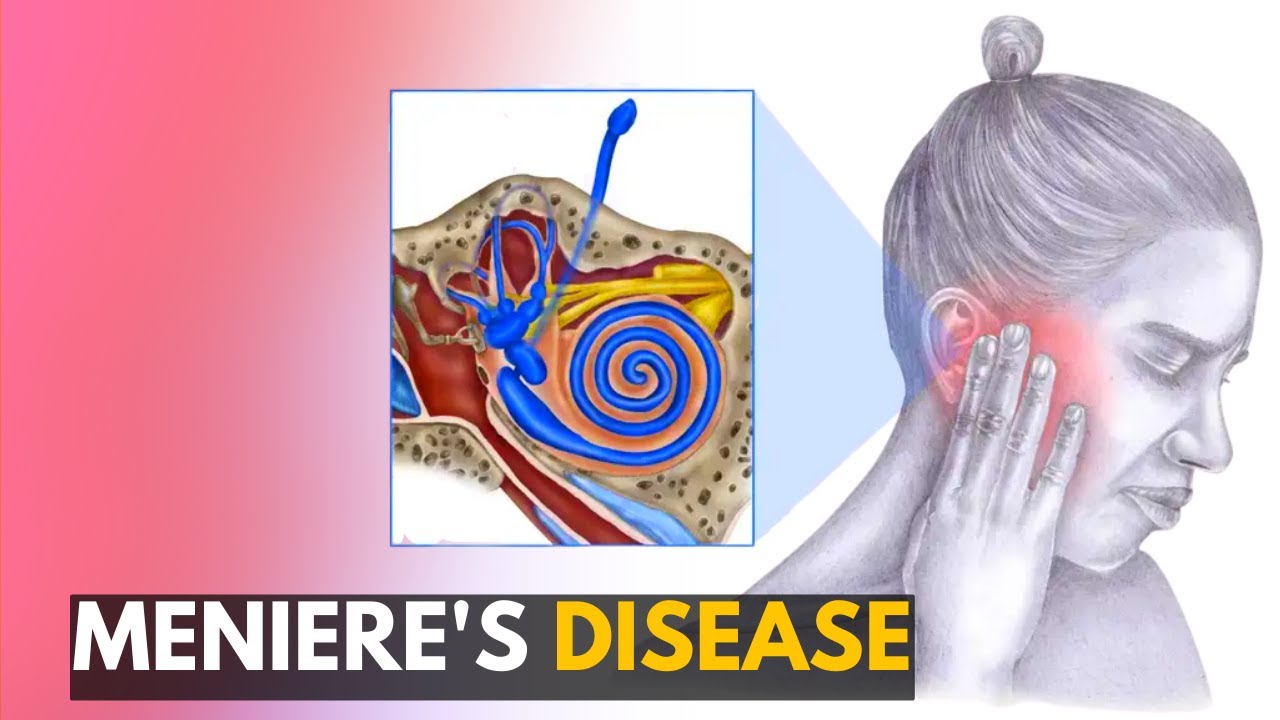 Meniere's disease: Everything You Need to Know