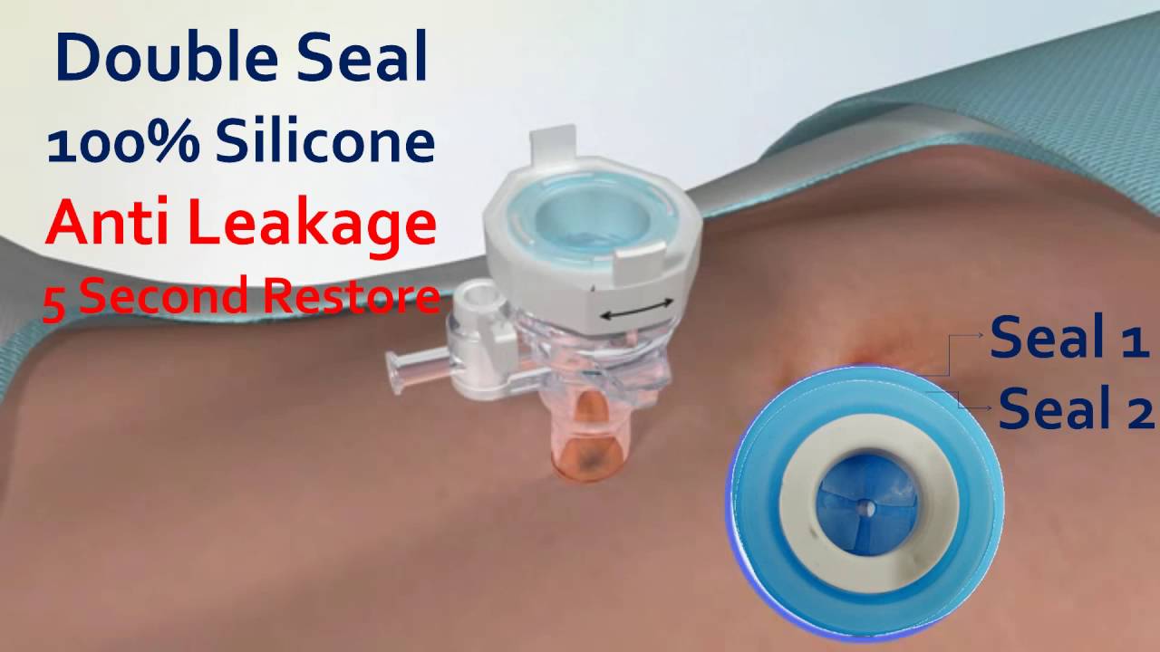 5 FEATURES TROCAR LAPAROSCOPIC YOU SHOUD KNOW