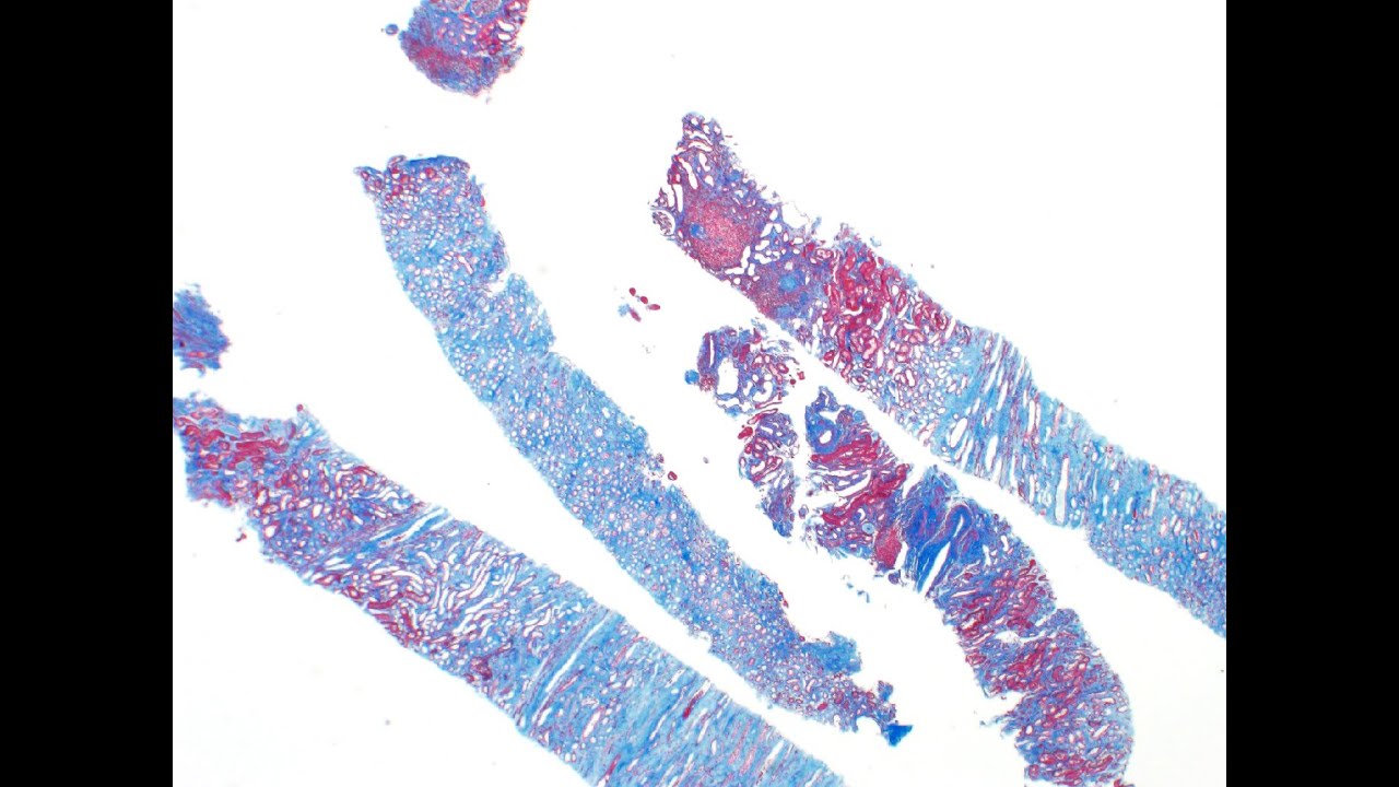 Collidescope Ep 5 | Kappa Light Chain Deposition Disease & Membranous Glomerulopathy, NELL1-Positive