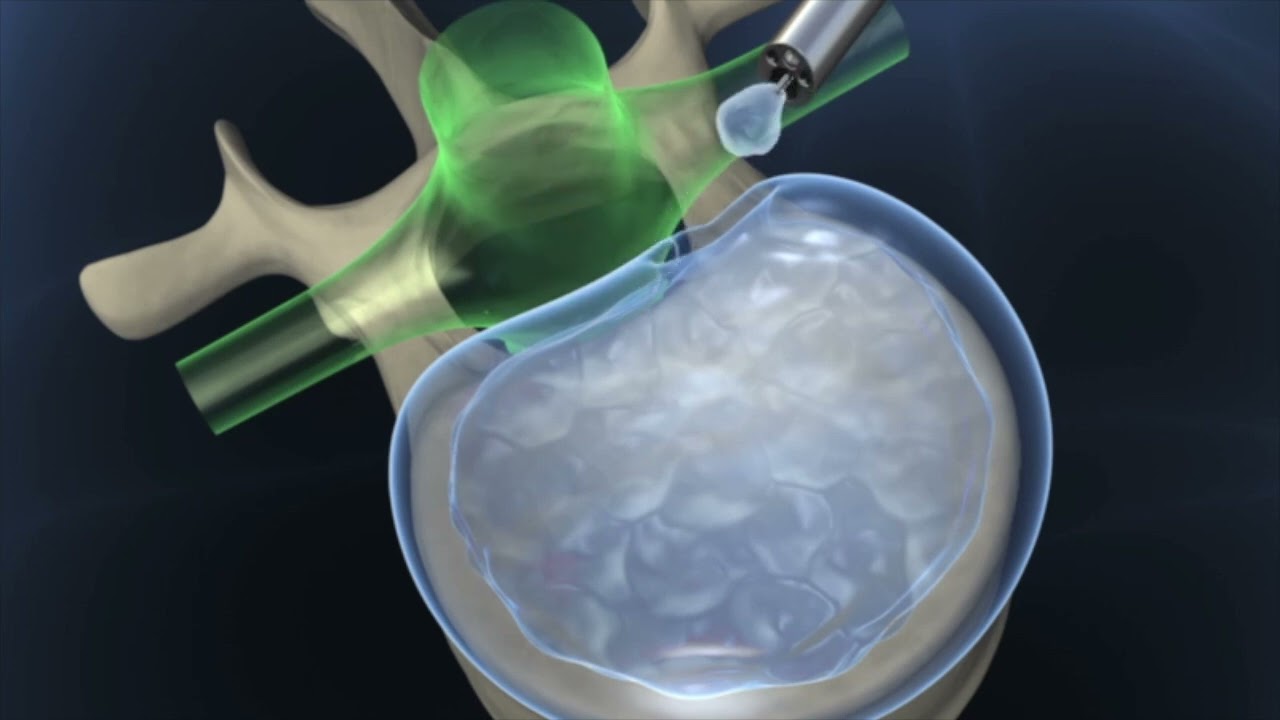 Transforaminal endoscopic spinal surgery with voiceover narration