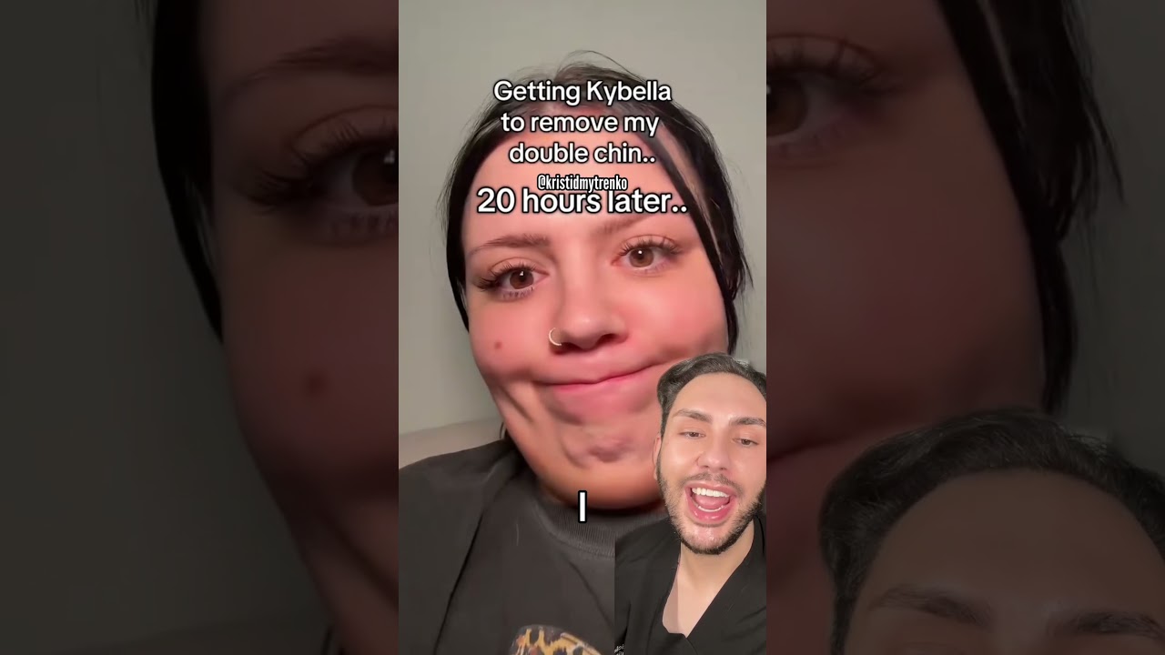 Get rid of a double chin (kybella/belkyra)