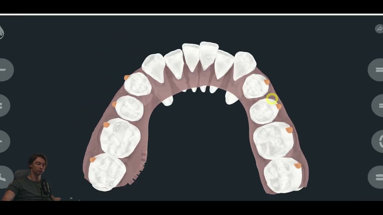 Case study №6, distalization of 4 segments with miniscrews | in-office aligners