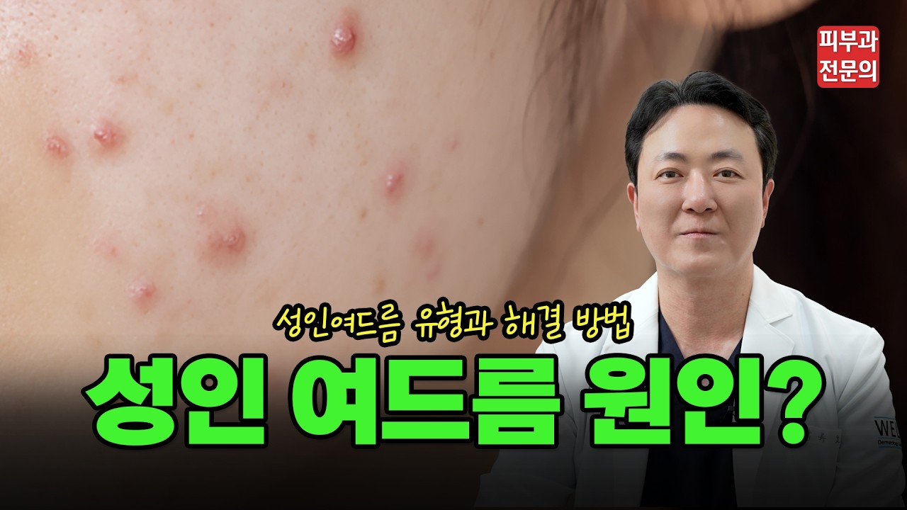 사춘기도 아닌데 반복되는 성인 여드름? 원인과 여드름 흉터 치료 접근법!