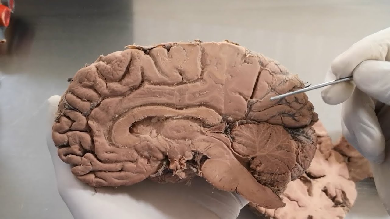 CEREBRO esp&eacute;cimen REAL - NEUROANATOMIA