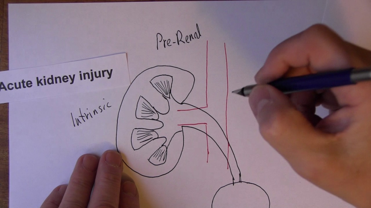 Acute Kidney Injury 1, Pre Renal Causes of AKI