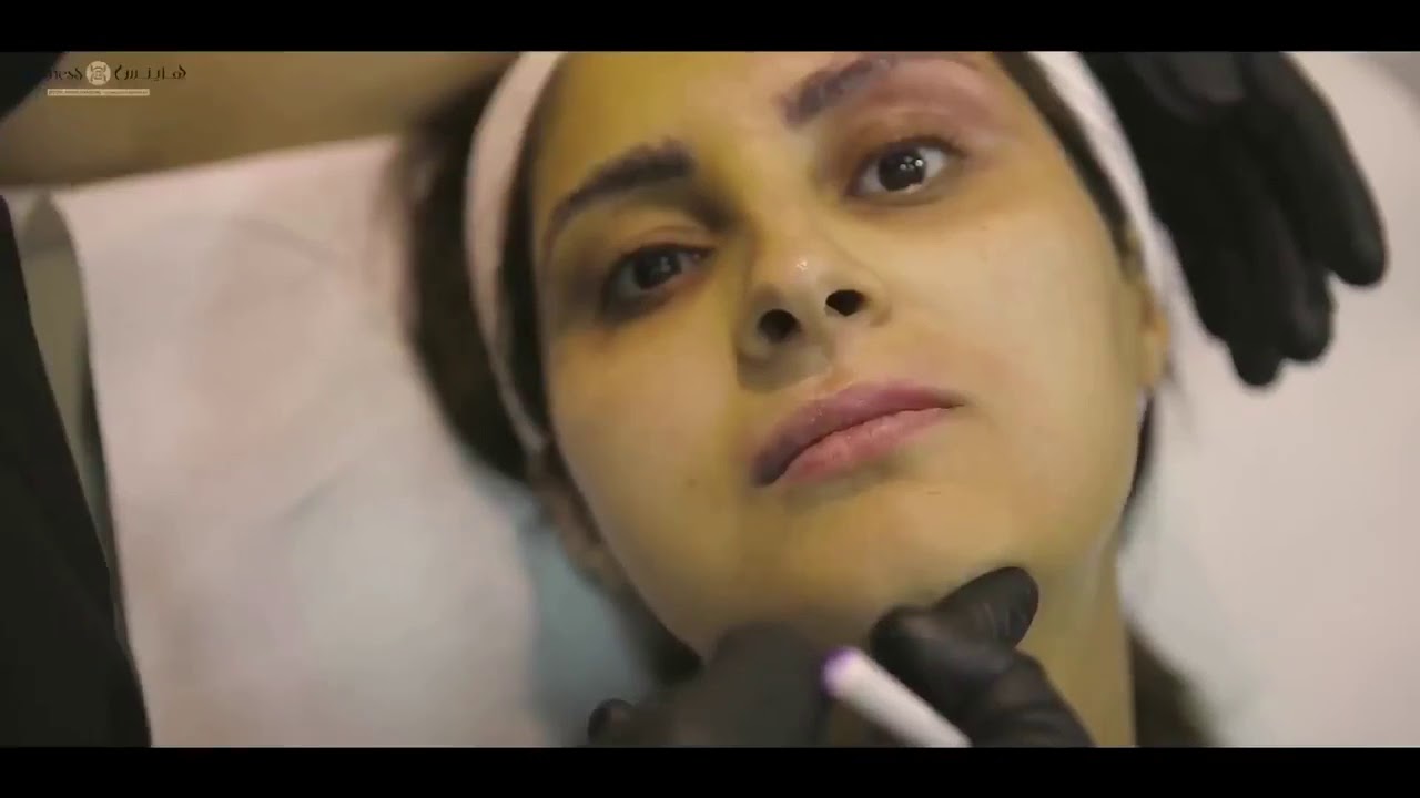 رفع الحواجب لابراز ملامح العين تجميل وتصحيح الانف بالفيلر تحديد ونحت الفك بابر الفيلر تكساس