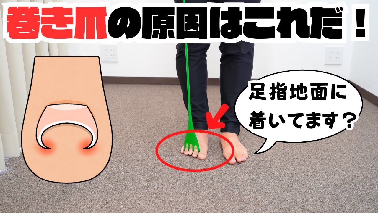 巻き爪の原因はコレだ！足指を鍛えよう！