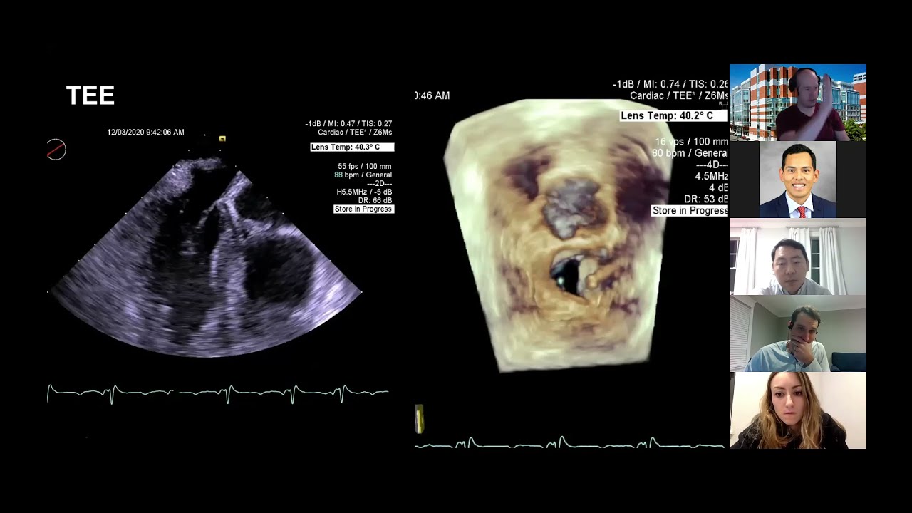 ZC S2E4: Flail Mitral Leaflet
