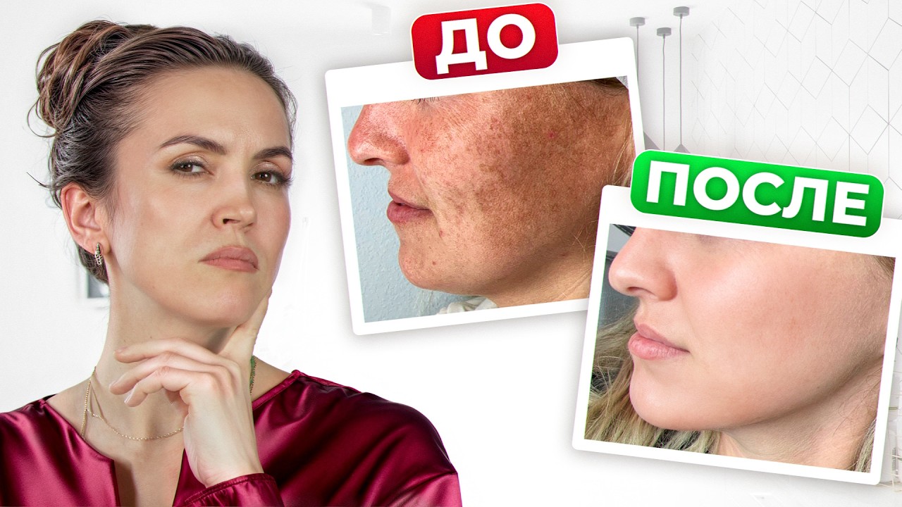 ГЛАВНАЯ ошибка в борьбе с пигментацией: вот почему становится хуже