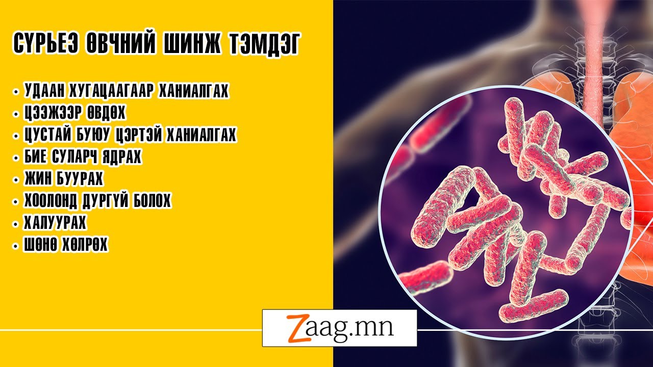 Сүрьеэ бол эдгэрдэг өвчин
