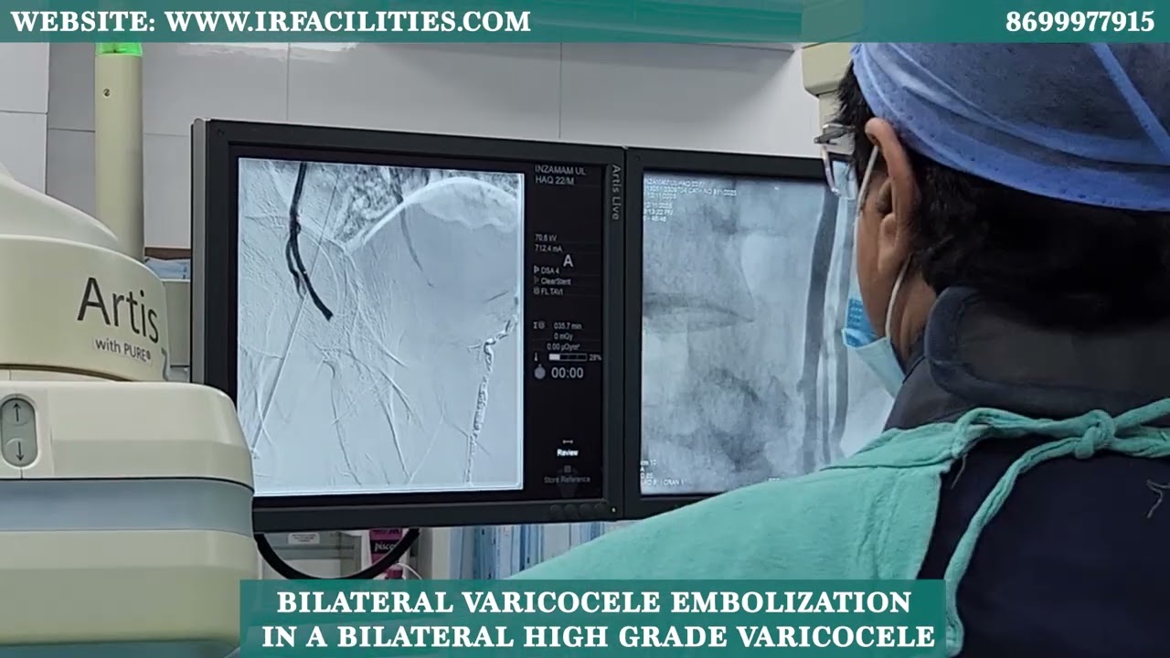 Bilateral Varicocele Embolization for High-Grade Varicocele | Minimally Invasive Treatment