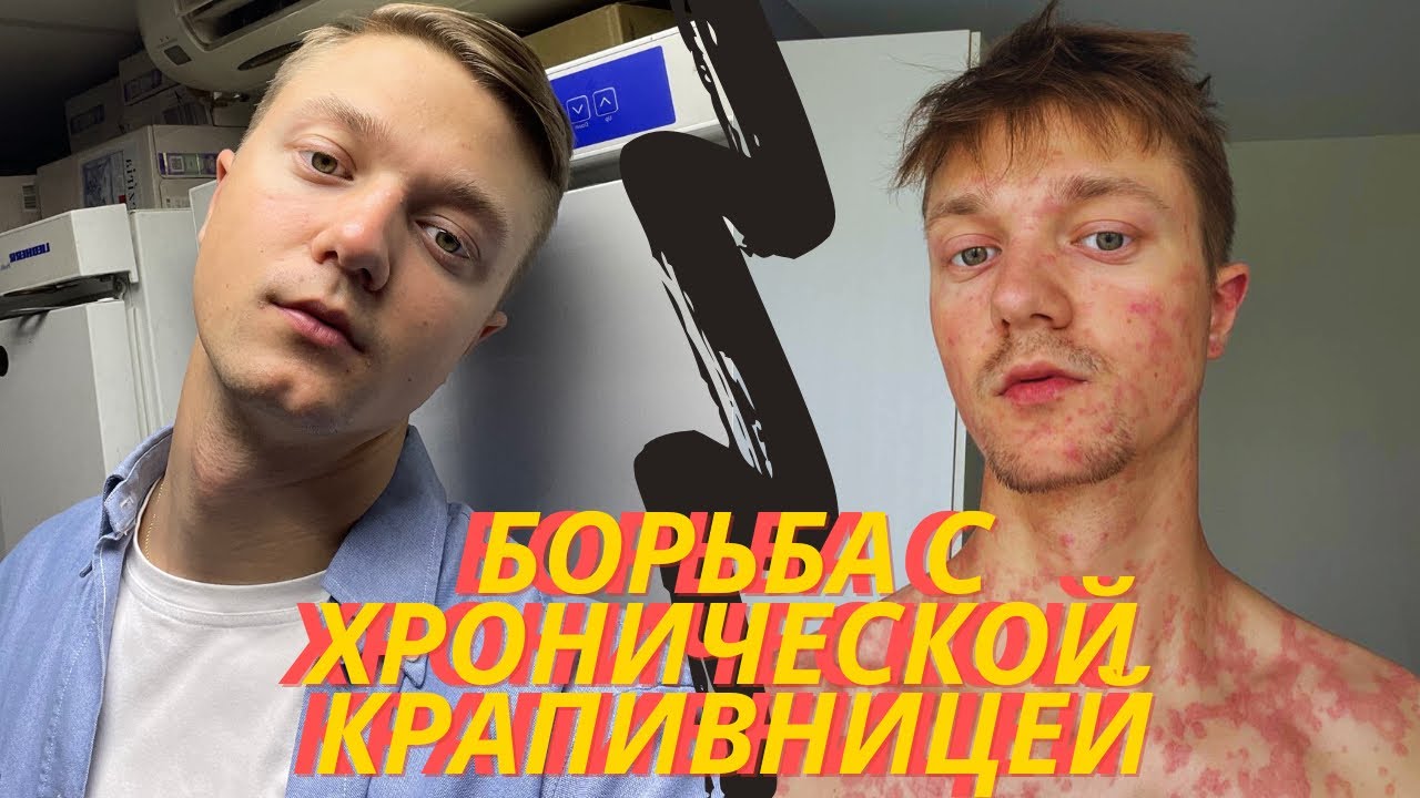 ХРОНИЧЕСКАЯ КРАПИВНИЦА: МОЯ ИСТОРИЯ СТРАДАНИЙ И ЛЕЧЕНИЯ 😰❤️‍🩹💉