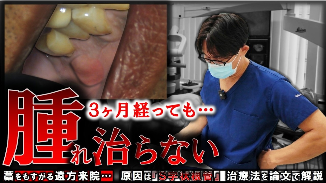 ３か月経っても治らない「腫れ&hellip;」藁をもすがる遠方来院、原因はＳ字状根管