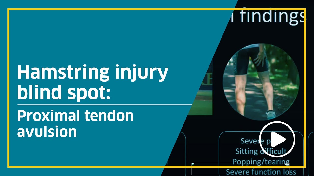 Hamstring injury blind spot: Proximal tendon avulsion